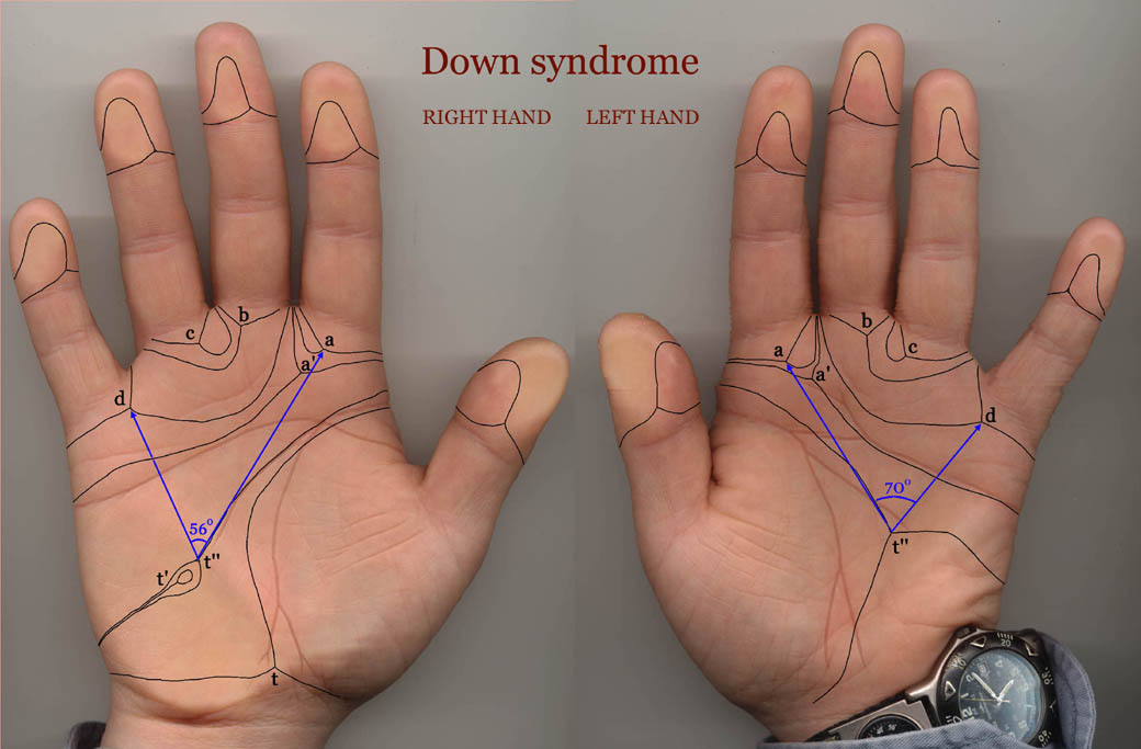 Down Syndrome The Hand 32 Hand Signs Trisomy 21