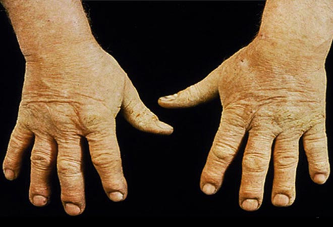 Dermatitis On Hands. Eczema in hands - irritant