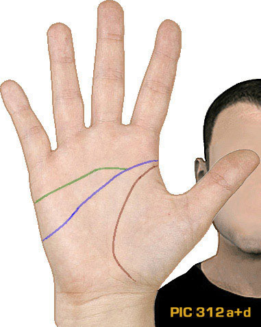 Example of PIC-variant 312a+d: the 'proximal' simian-Sydney crease, which is not connected to the life line but does cross the full palm.