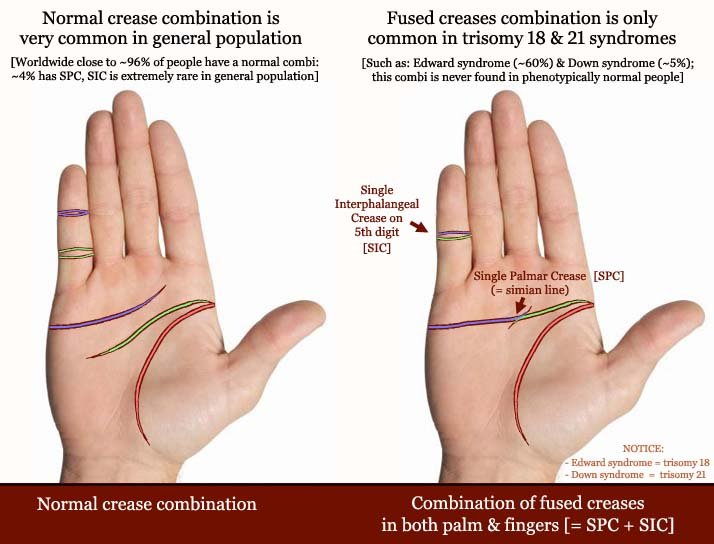 Simian Line Single Transverse Palmar Crease Page 2