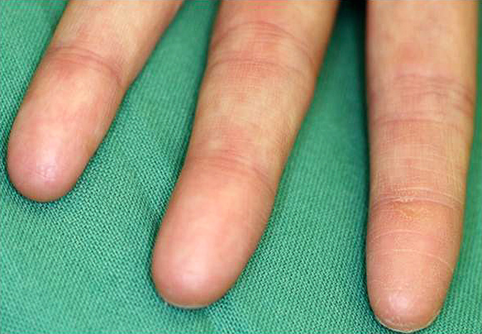 adermatoglyphia-the-genetic-missing-fingerprints-disease