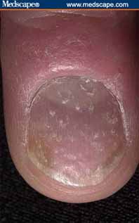 Psoriasis nail pitting