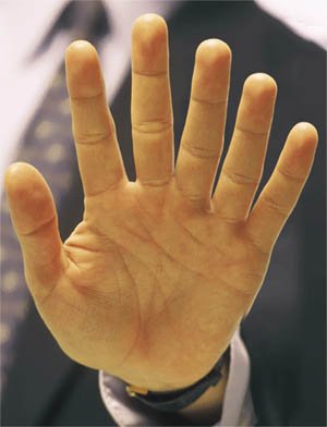 fingers finger six extra palm little inbreeding hand polydactyly does pinky lines rare palmistry give mutations indian fingered human reading