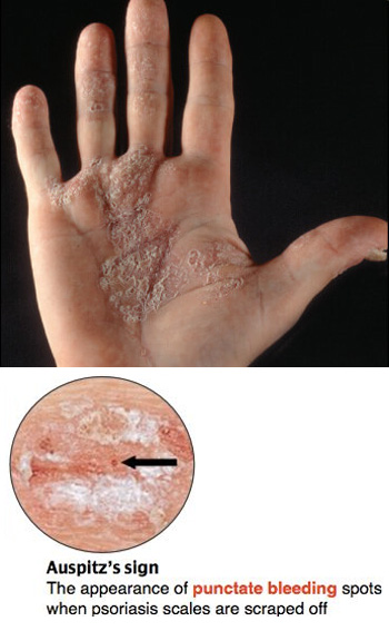 Auspitz sign: punctate bleeding spots below scales.