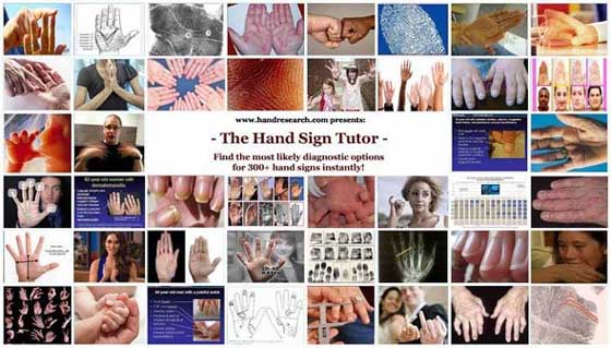 The Hand Sign Tutor: find the most likely diagnostic options for 300+ hand signs instantly